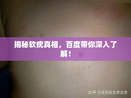 揭秘软疣真相,百度带你深入了解!